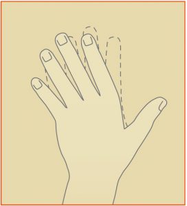 Rheumatoid_Fig2[1]