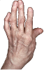 Hand-Arthritis