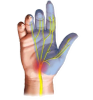Carpal tunnel syndrome