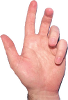 Dupuytren's contracture