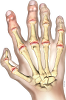 Hand osteoarthritis