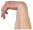 Hand spasticity