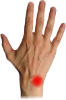 Kienböck's disease
