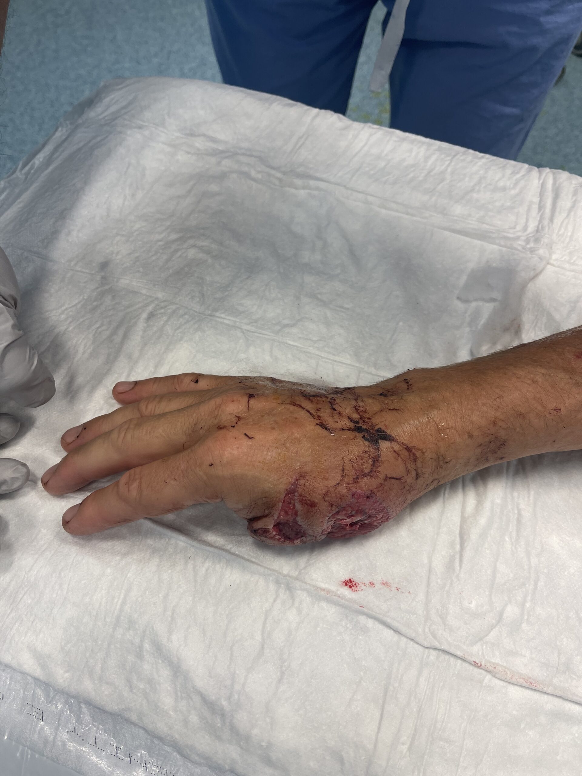 Complex thumb and hand soft-tissue injury before flap reconstruction