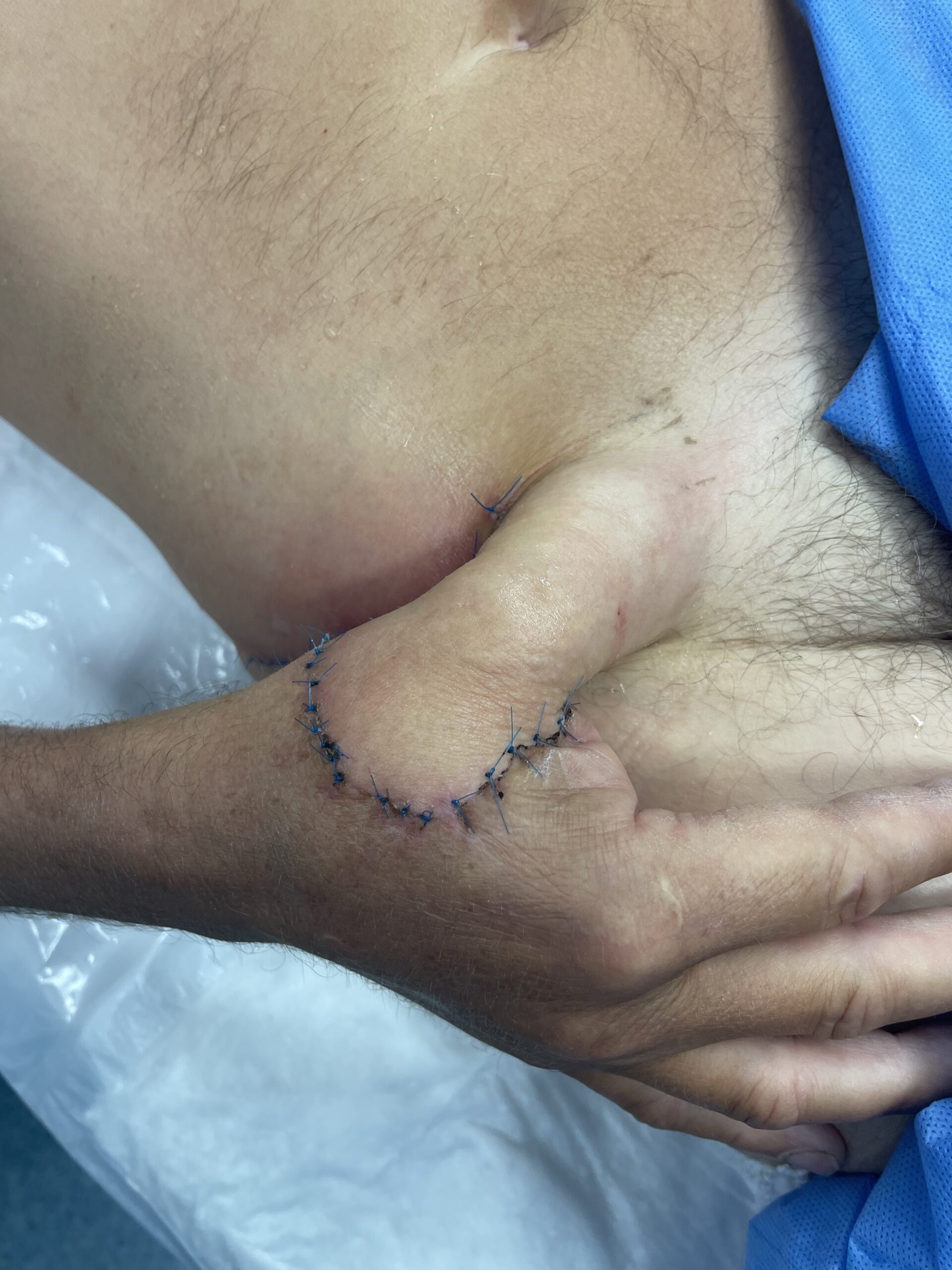 Groin flap reconstruction providing soft-tissue coverage for a hand injury