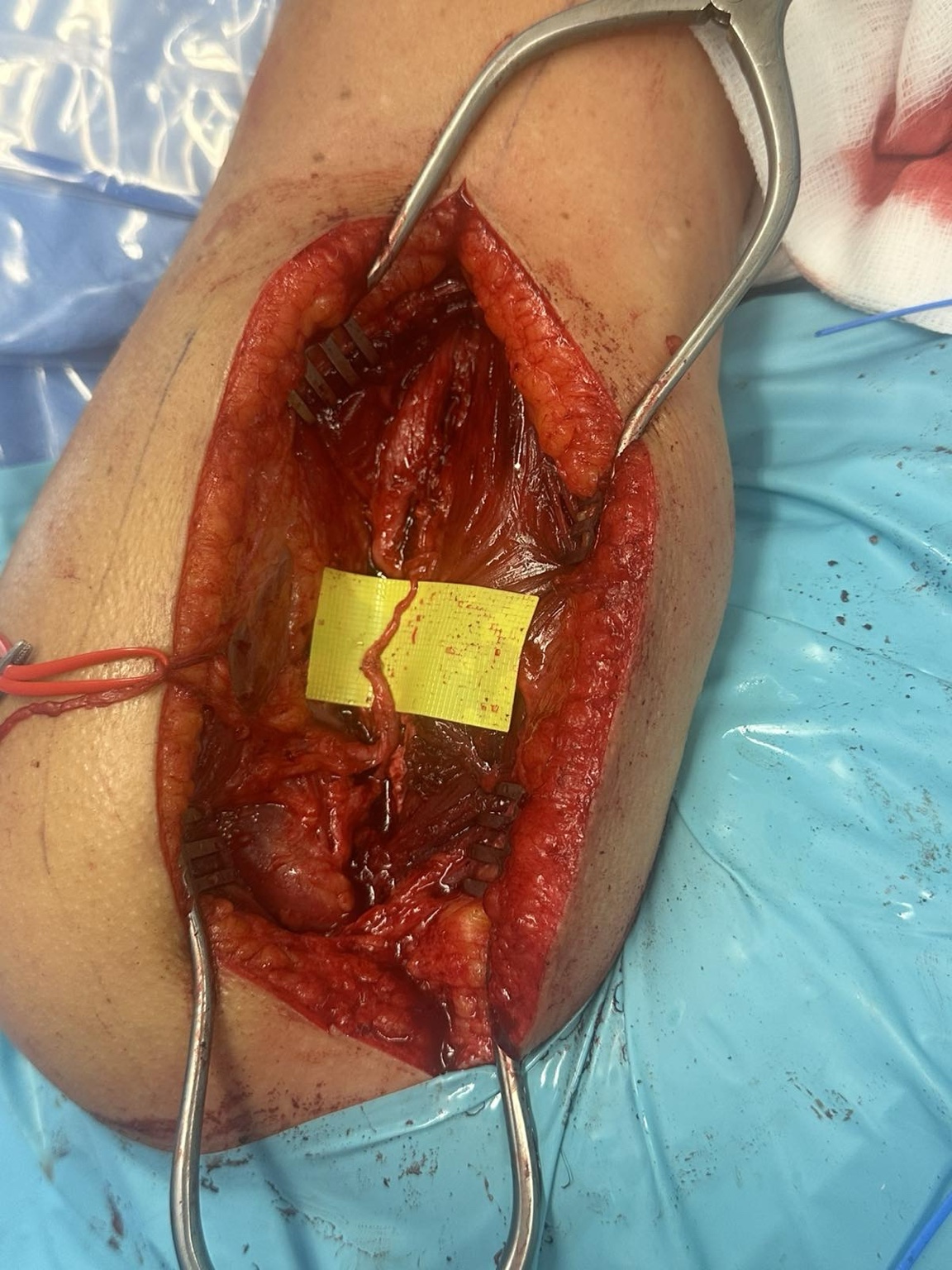 Intraoperative nerve transfer for brachial plexus injury — image 7