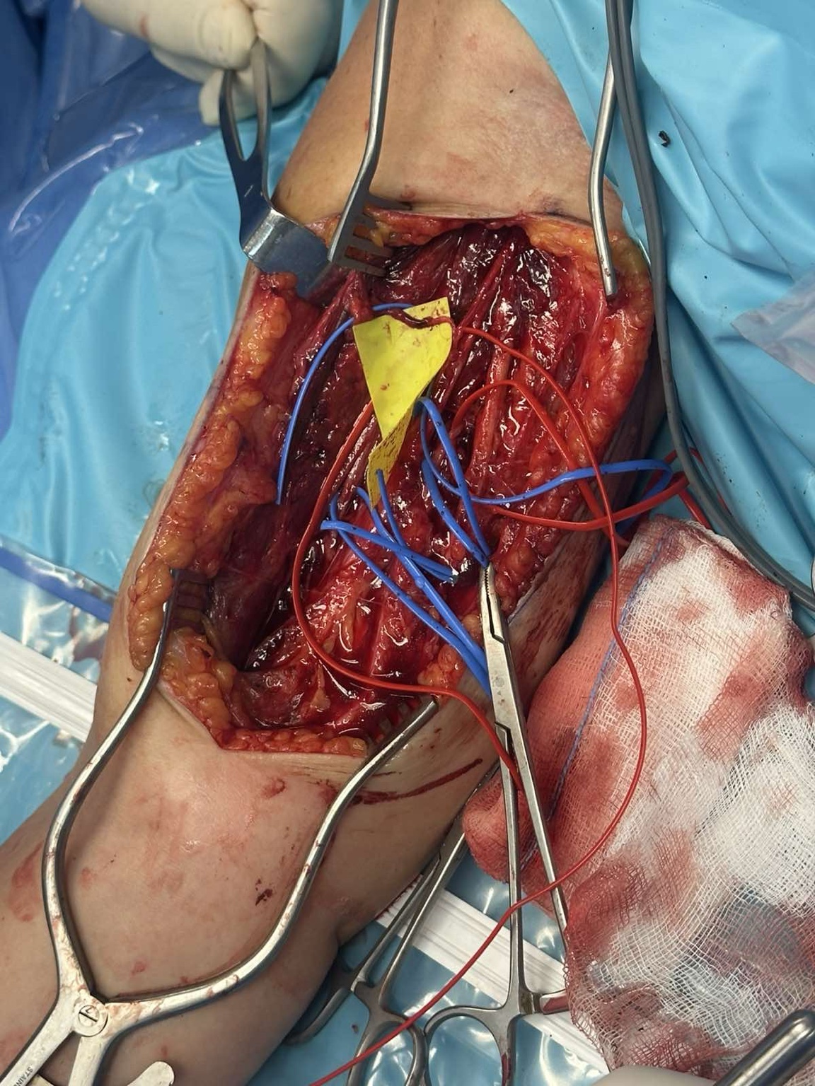 Intraoperative nerve transfer for brachial plexus injury — image 4