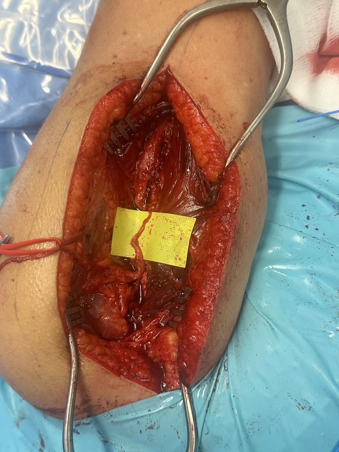 Intraoperative nerve transfer for brachial plexus injury — image 3