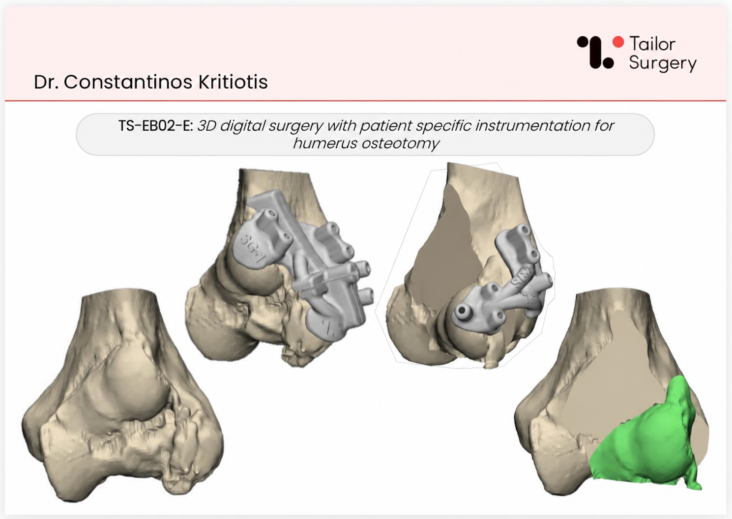 Planning and patient-specific guides for distal humerus osteotomy