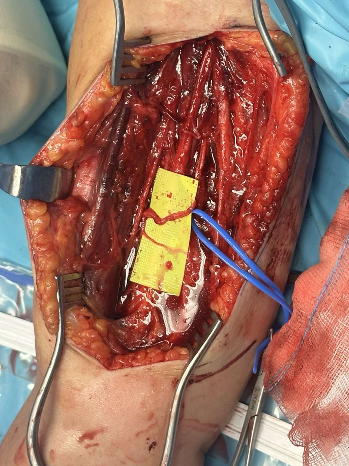 Intraoperative nerve transfer for brachial plexus injury — image 2