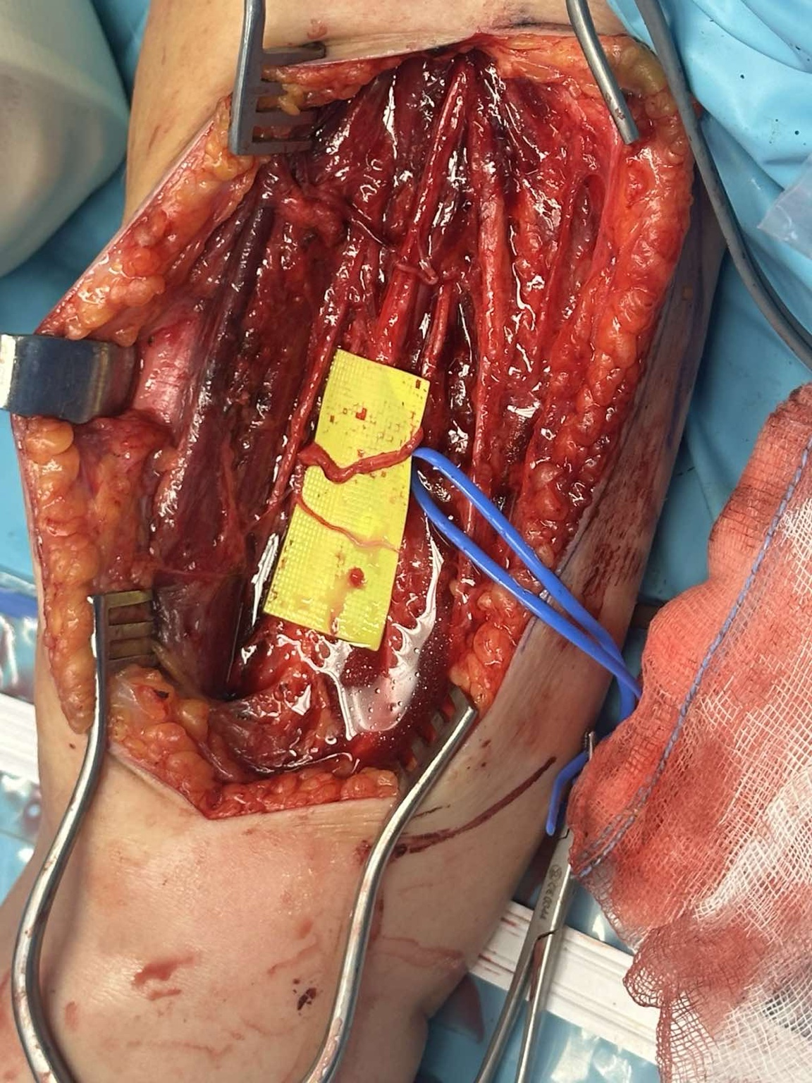 Intraoperative nerve transfer for brachial plexus injury — image 5