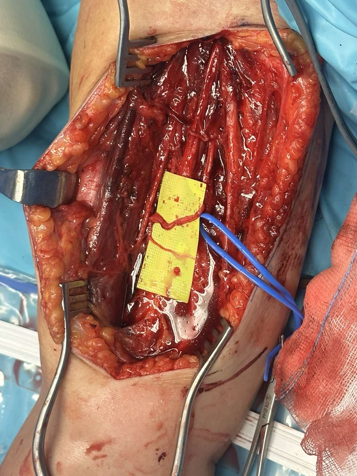 Intraoperative nerve transfer for brachial plexus injury — image 6