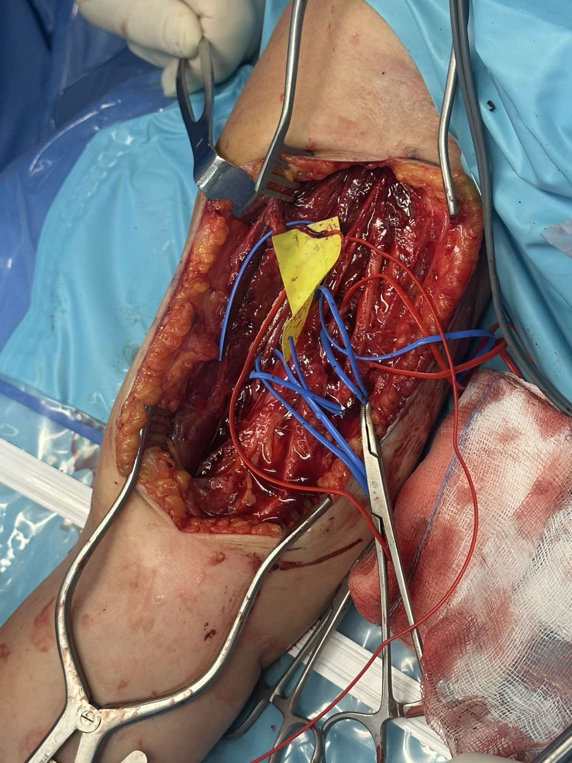 Intraoperative nerve transfer for brachial plexus injury — image 1