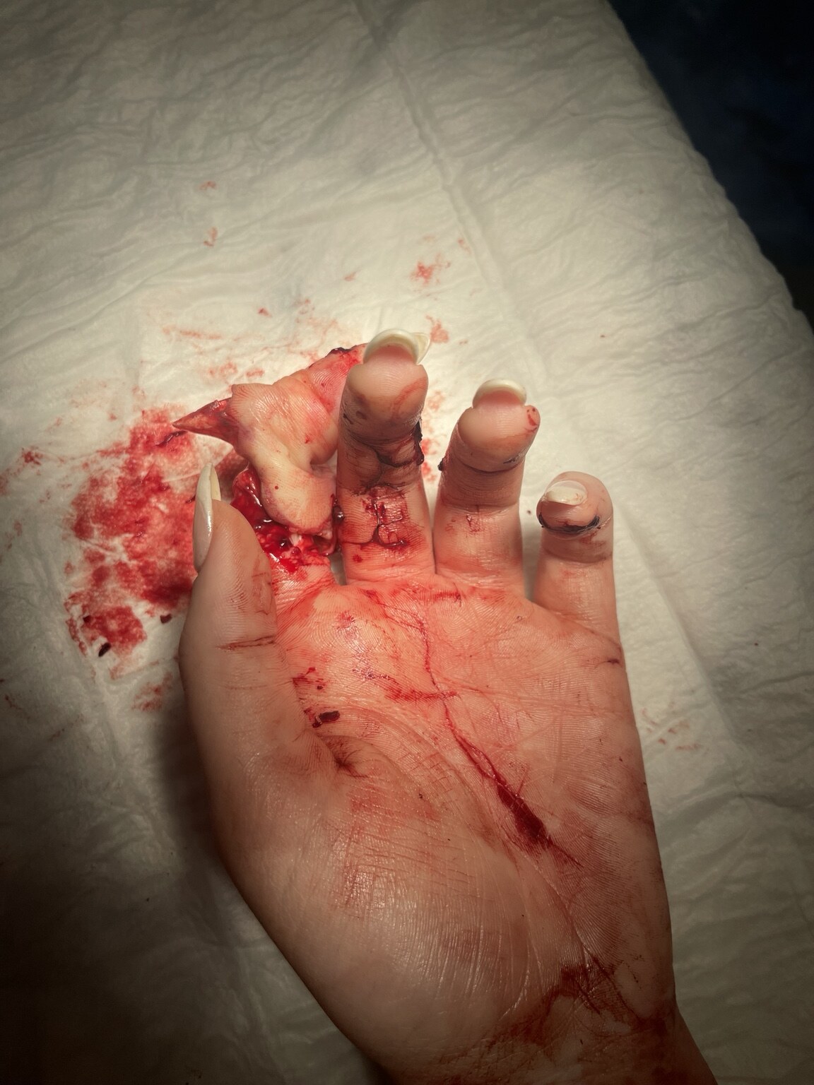 Degloving injury of the index finger before revascularisation under WALANT, palmar view