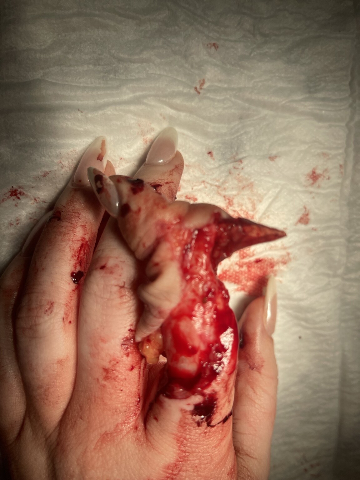 Close-up of index-finger degloving injury before revascularisation under WALANT