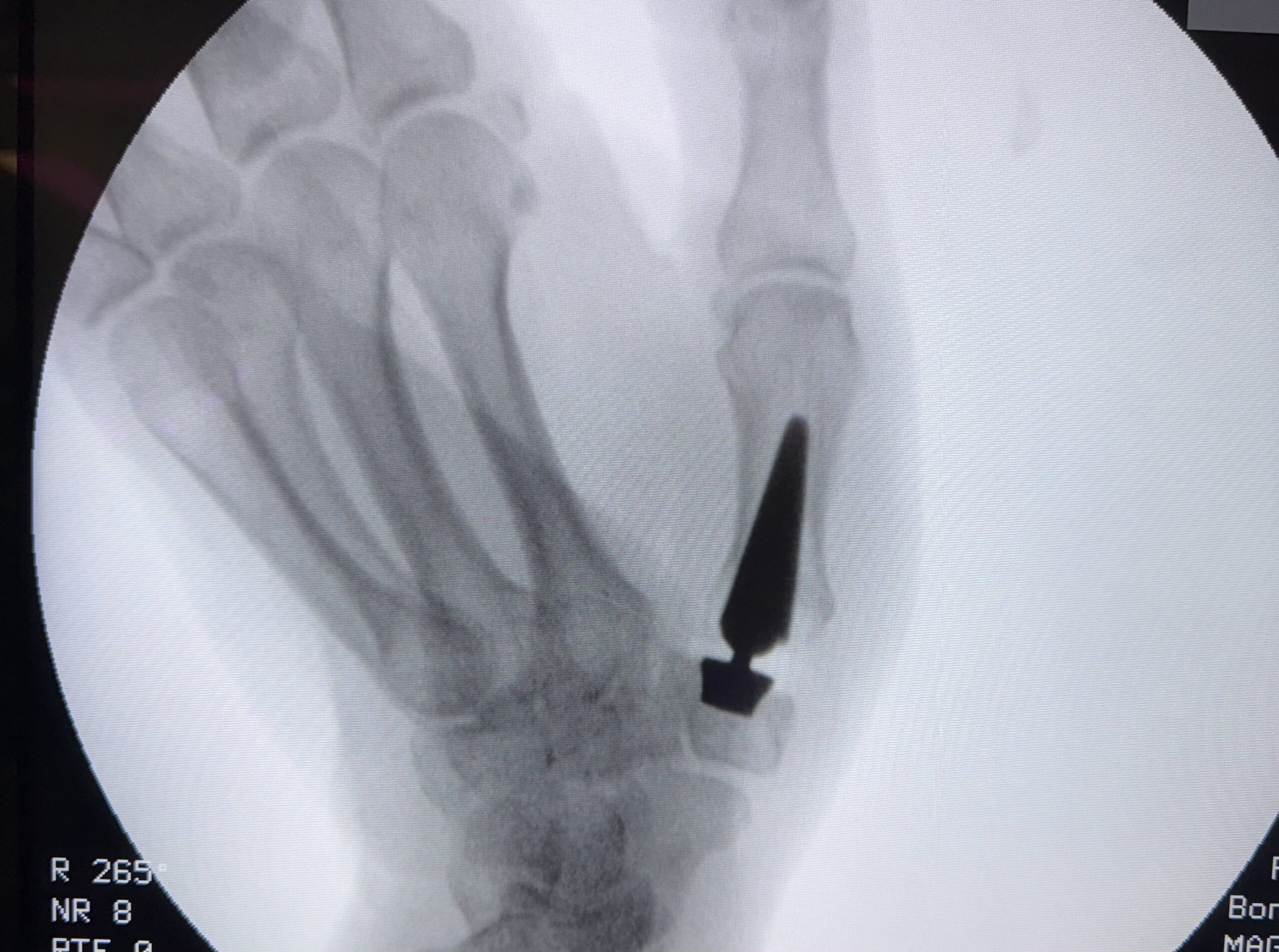Postoperative X-ray showing Touch CMCJ prosthesis