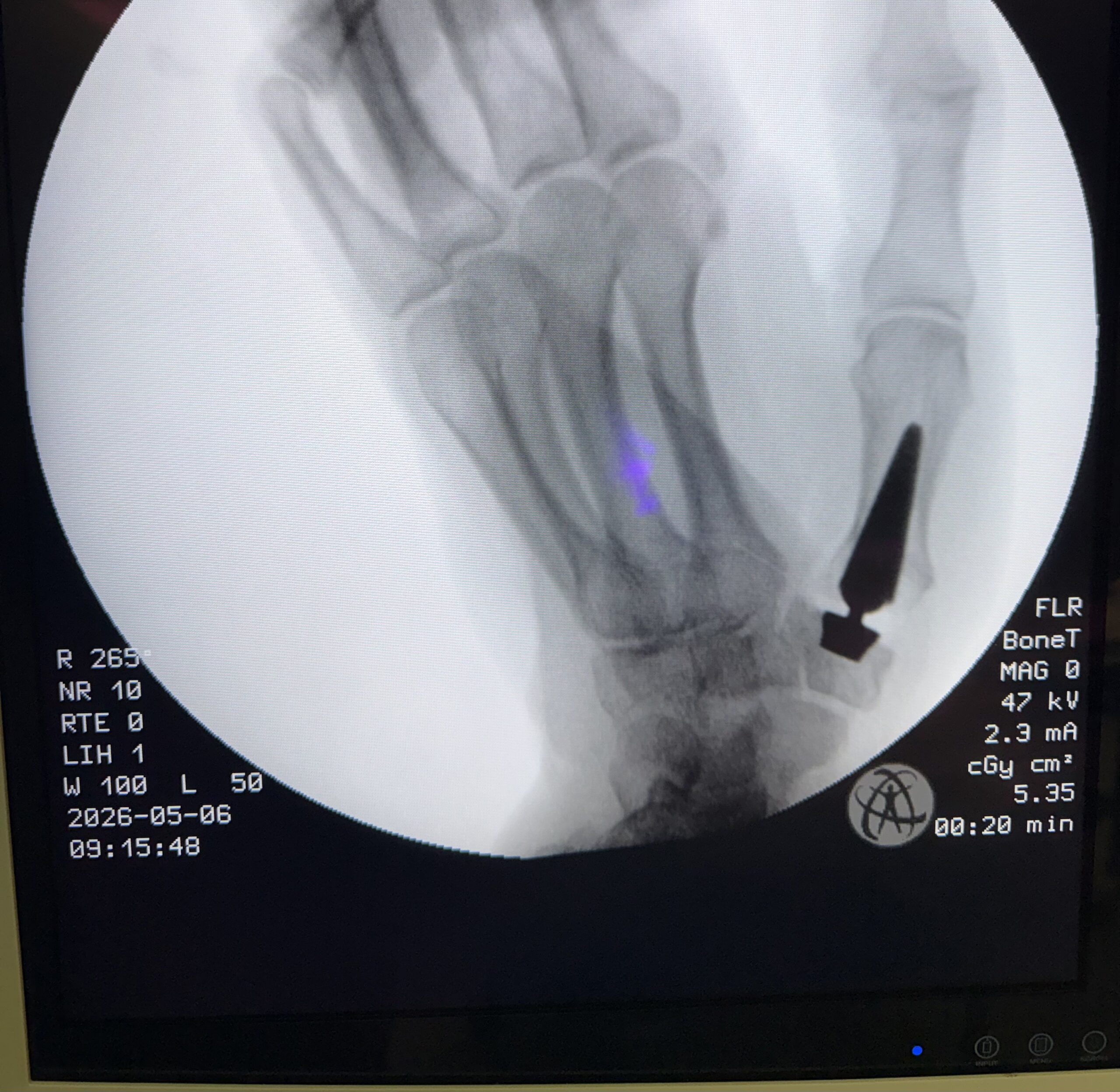 Postoperative X-ray showing Touch CMCJ prosthesis in an alternate view